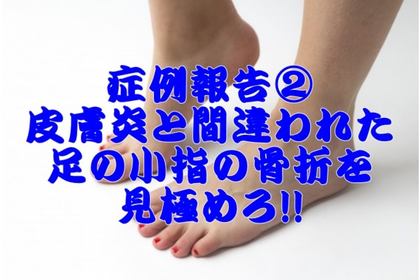 横浜中区元町にある整体/整骨院壱番館が足の小指の骨折について解説